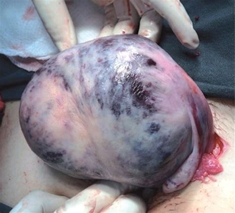 descolamento de placenta fotos - bolsa de valores ibovespa